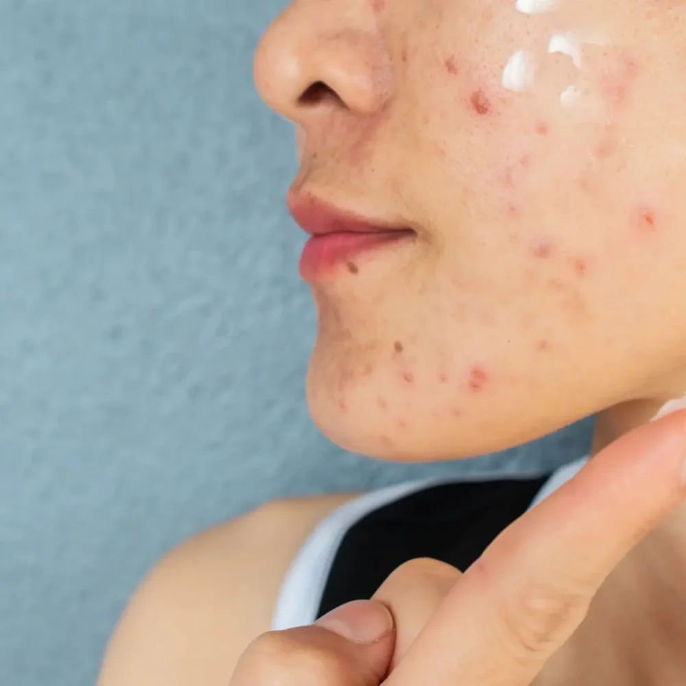 Acne Treatments
