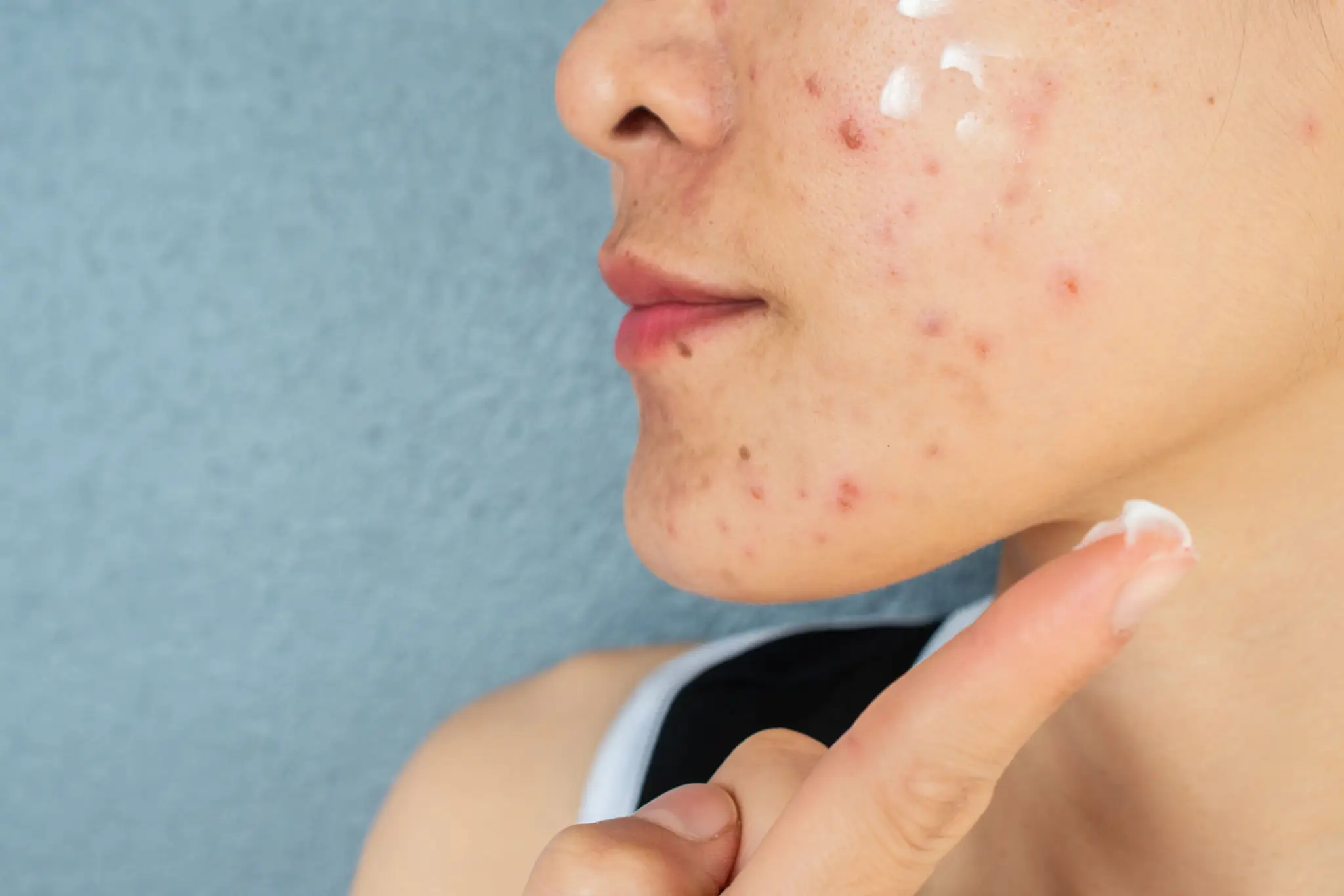 Acne Treatments